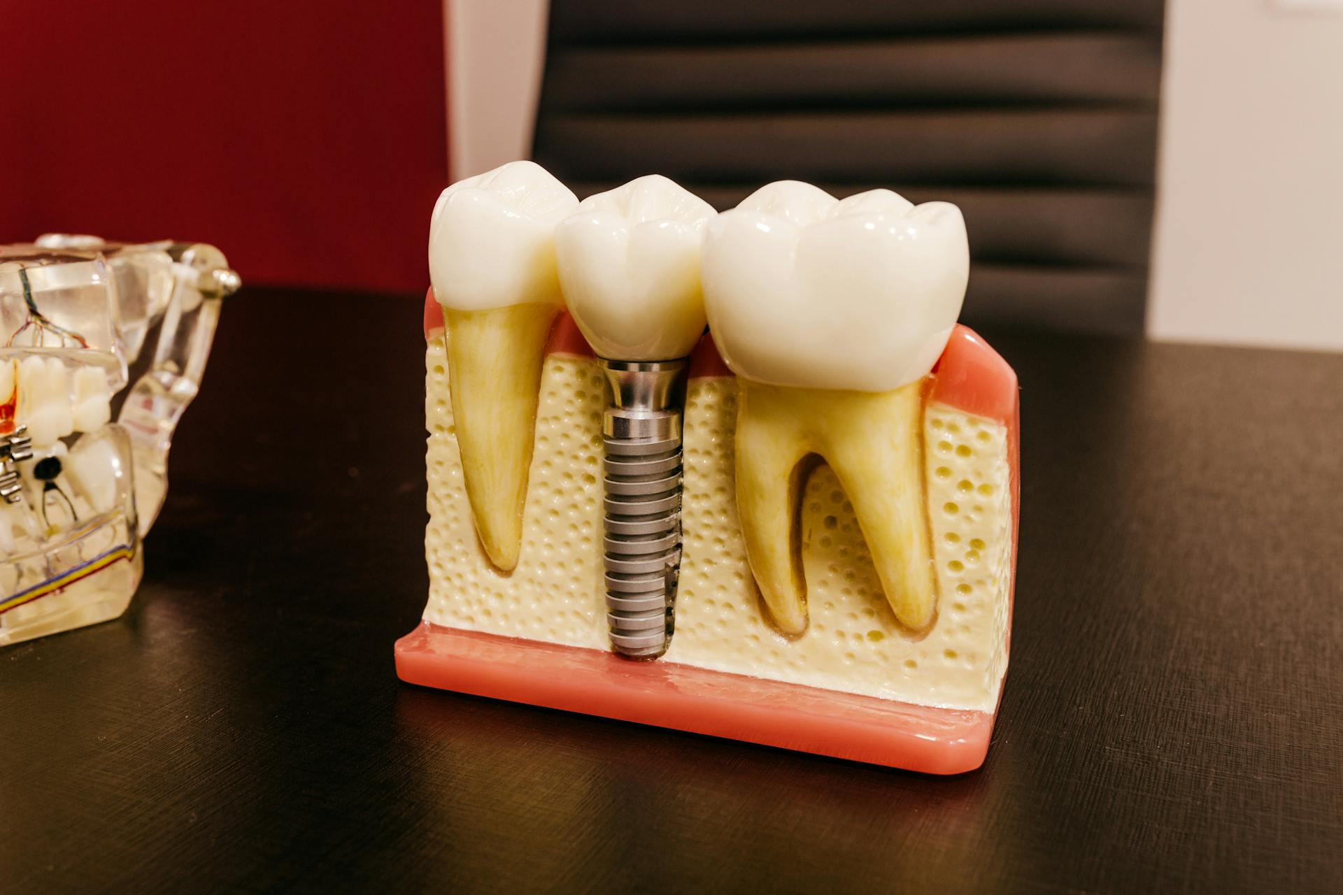 Implant ceramic versus implant din titan – ce alegere este mai potrivită pentru tine?