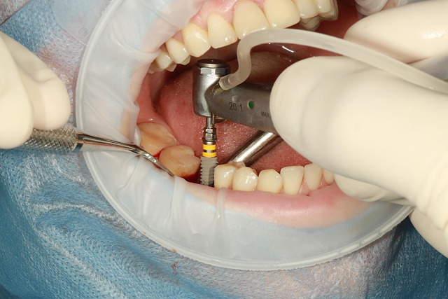 Implanturile dentare: mit versus adevăr